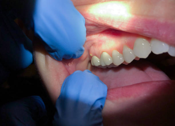 Best Emergency Root Canal Treatment in Riner, VA